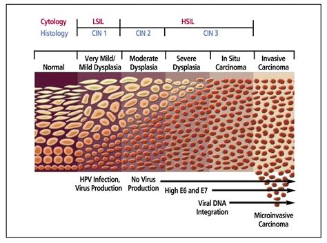 Anal Cancer And Screening Guidelines For Human Papillomavirus In Men