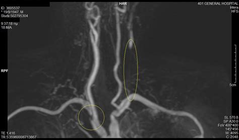 Primary Stenting Of Right Sided Subclavian Artery Stenosis Presenting As Subclavian Steal