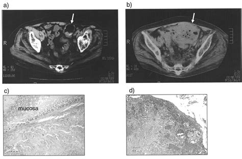 Ct And Pathological Findings Of Case Patient No A Ct At