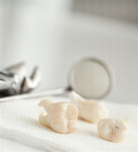 Wisdom Tooth Extraction San Ramon | Oak Ridge Dental