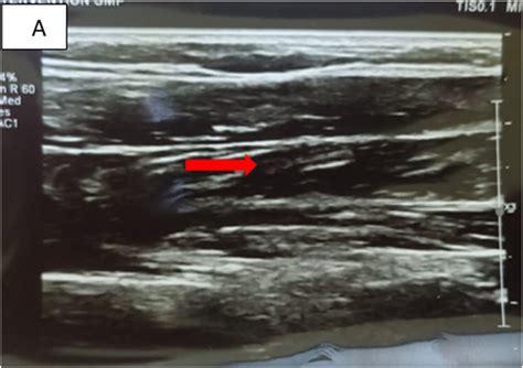 A Plain Radiograph With Soft Tissue Swelling In The Proximal 13rd Of