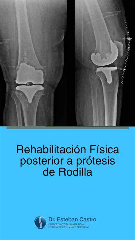 Ejercicios De Rehabilitaci N F Sica Posterior A Artroplast A Pr Tesis