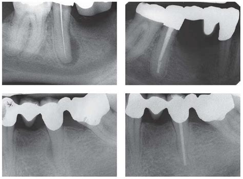 12: Root canal filling materials | Pocket Dentistry