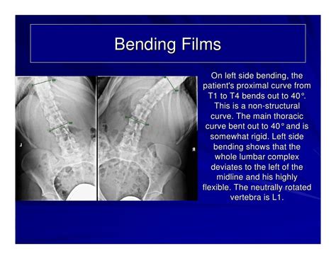 Case Review 4 Adolescent Idiopathic Scoliosis With 61 Degree Curvat