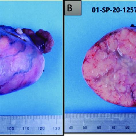 A Gross Appearance Of An Ovarian Juvenile Granulosa Cell Tumor