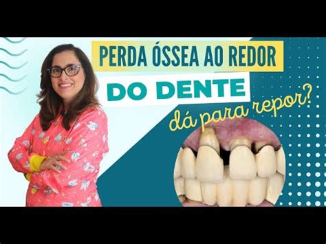 Perda Ssea Ao Redor Do Dente D Para Recuperar Adornare Odontologia