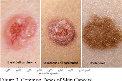 The 3 Types Of Skin Cancer Cancerwalls