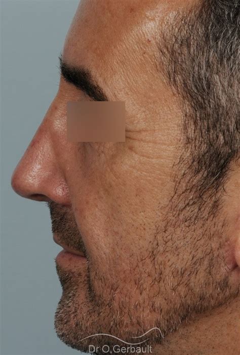 Photos de rhinoplastie chez l homme avant et après