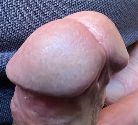 Hypospadias Cock 62 Pics Xhamster