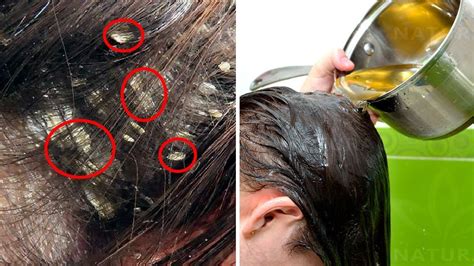 3 Home Remedies To Get Rid Of Dandruff Naturally Artofit