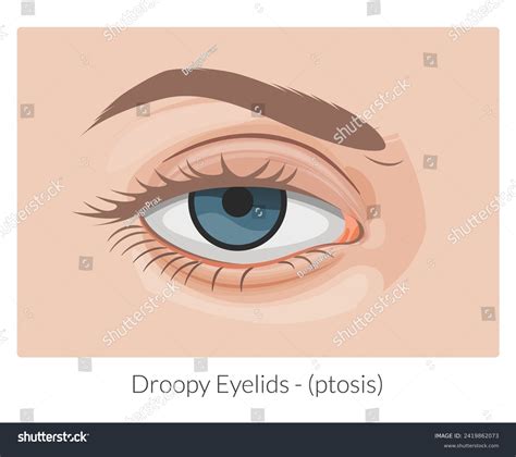 Ptosis Drooping Upper Eyelid Stock Royalty Free Stock Vector