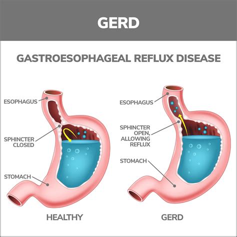 Esophageal Disorders Gastroenterology Of Greater Orlando