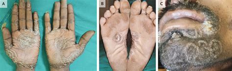 Hiv Rash Feet