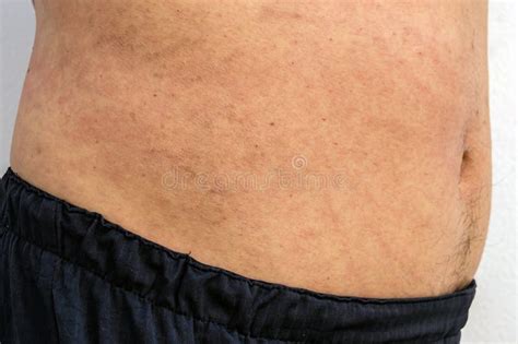 Itchy Body Rash Caused By Allergies On Middle Part Of Man Body Male