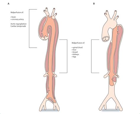 Aortic Dissection