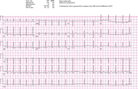 Focal Atrial Tachycardia Fat • Litfl • Ecg Library 49 Off