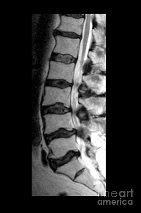 Severe Facet Joint Degeneration Photograph by Medical Body Scans