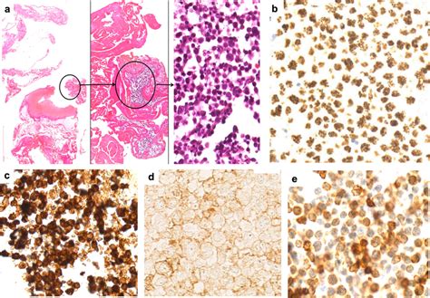 Example of primary effusion lymphoma with expression of T-cell markers ...