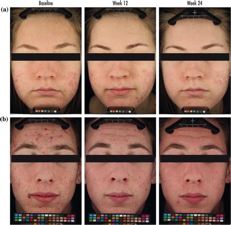 Adapalene 03 May Help Improve The Appearance Of Atrophic Acne Scars