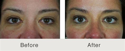 Xanthelasma Treatment and Excision by Facial Plastic Expert