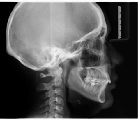 Conventional 2D lateral cephalic radiography. For this type of image ...