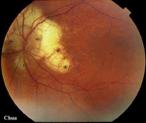 Case 55: Myopic degeneration