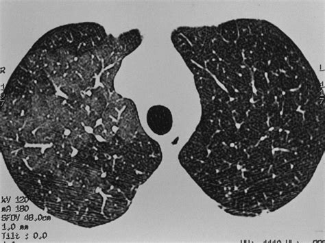 Clinical And Radiologic Features Of Pulmonary Edema Radiographics