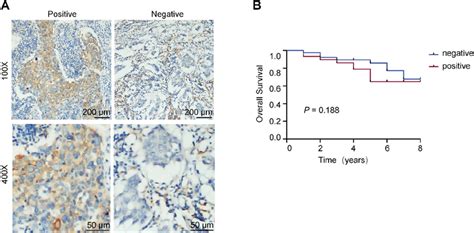 Pd L1 Expression In Tnbc Tissues A Examples Of Pd L1 Positive N 76