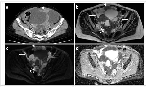 Jcm Free Full Text Diffusion Weighted Magnetic Resonance Imaging In Ovarian Cancer