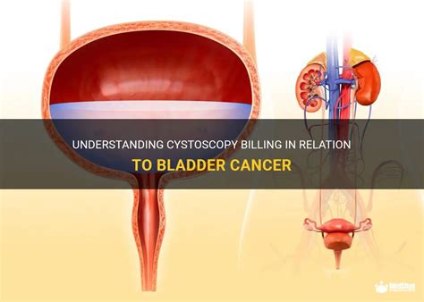 Understanding Cystoscopy Billing In Relation To Bladder Cancer | MedShun