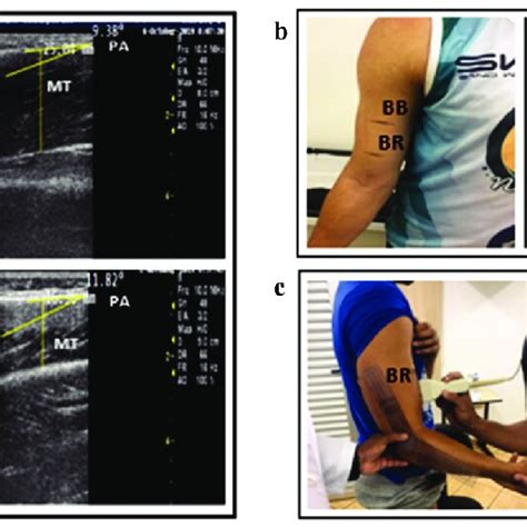 Ultrasound Imaging A Triceps Brachii B Biceps Brachii And