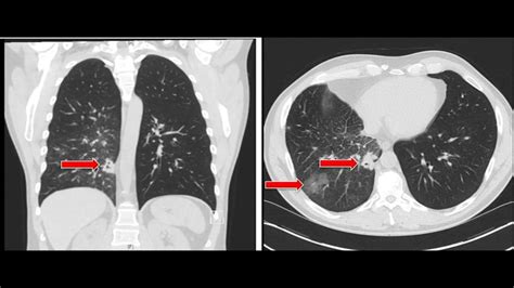 Health Watch: Targeting ALK Positive Lung Cancer - ABC30 Fresno