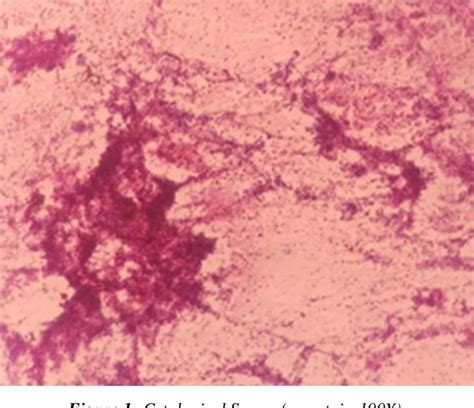 Figure 1 From Anaplastic Large Cell Lymphoma Of Breast Masquerading