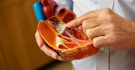 The Tavr Procedure Explained Multicare Pulse Heart Institute