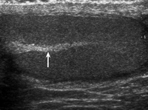 Normal Epididymis Ultrasound