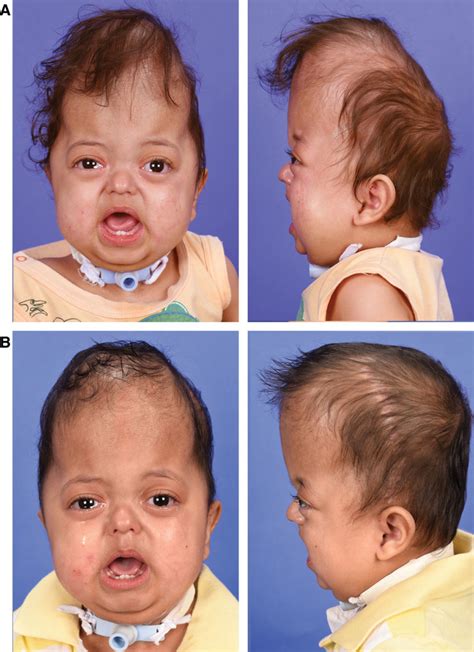 Pfeiffer Syndrome A Therapeutic Algorithm Based On A Modified Grading