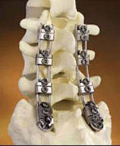 Biomechanical Evaluation Of Pedicle Screw Based Dynamic Stabilization