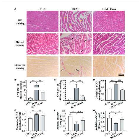 Canagliflozin Inhibits Oxidative Stress And Fibrosis In Diabetic