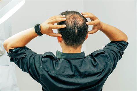 Male Pattern Baldness Causes And Treatments