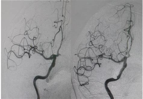 ] Acom aneurysm pre & after coiling | Download Scientific Diagram