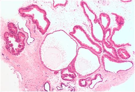 Fibrocystic Breast Disease Causes and Treatments