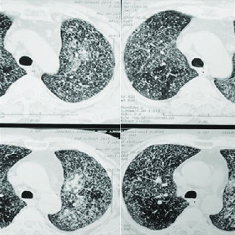 High Resolution Computed Tomography Of Chest Showing Bilateral