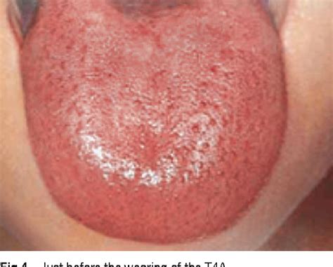 Figure 4 From Simple Myofunctional Therapy Using Ready Made Mouthpiece