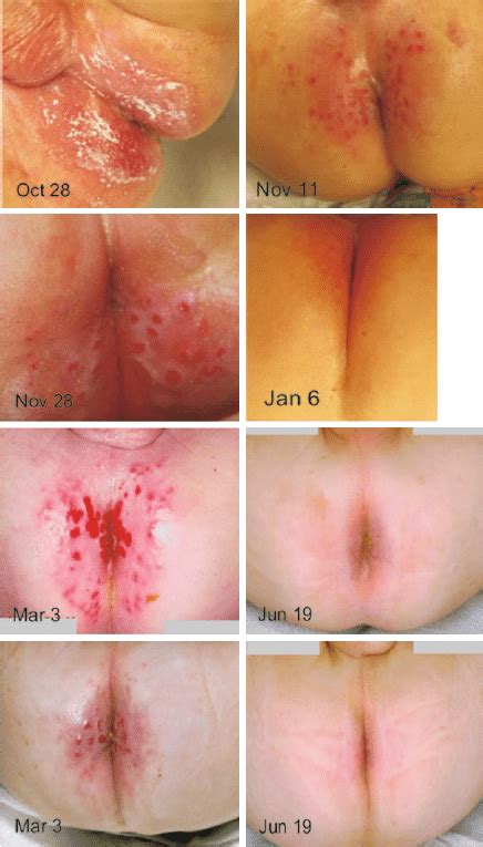 Photographs Of Perianal Skin Conditions In Patients Before And