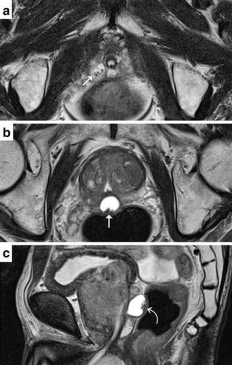 Prostate Mr Images Axial T2 Weighted Images A B Showed Two Cystic