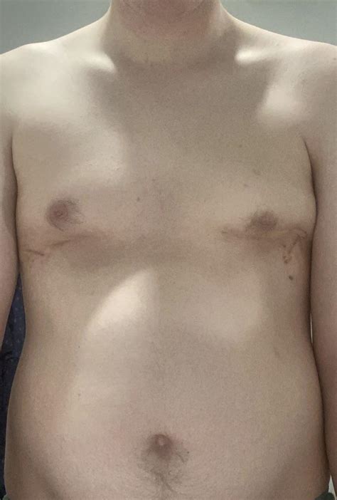 3 Weeks Post Op My Bar Pushes Up On My Boob So When I Look In The