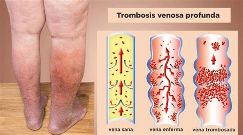 Embolia pulmonar qué es síntomas causas y tratamiento