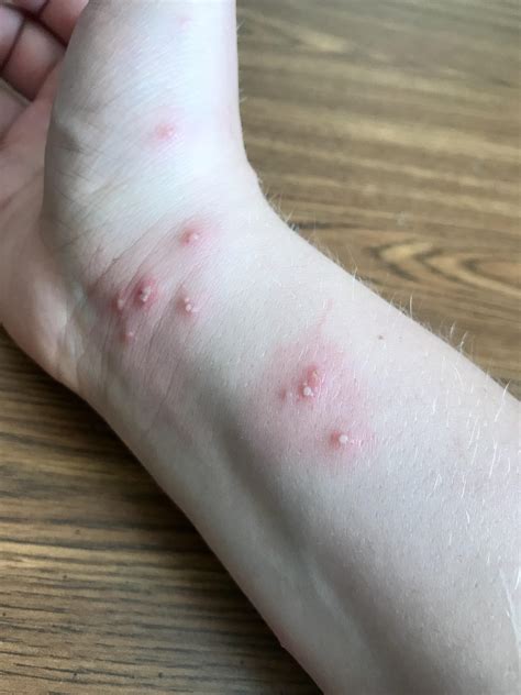 Red Ant Bites