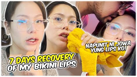 7 DAYS RECOVERY FROM BIKINI LIPS OPERATION