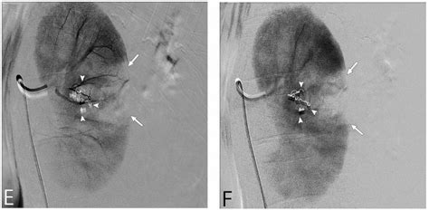 Renal Biopsy | Radiology Key